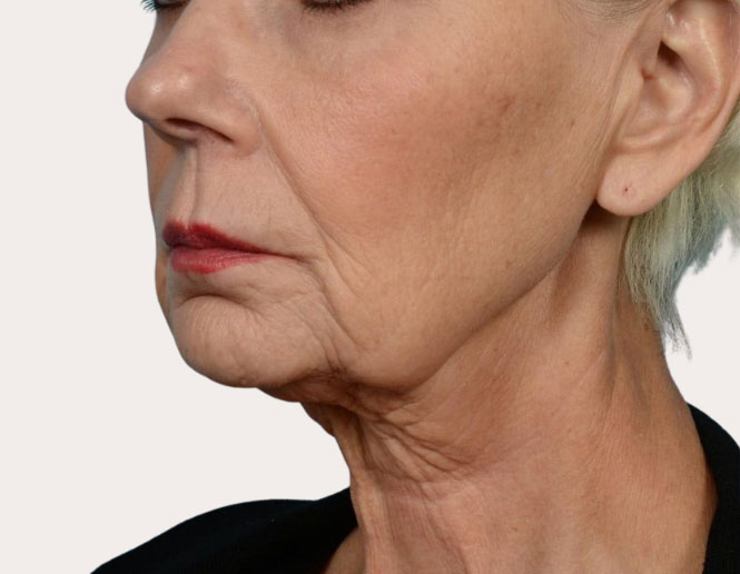 neck lift before picture